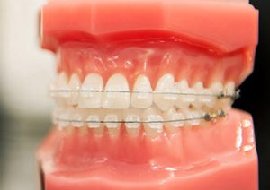 Ceramic (transparent) brackets